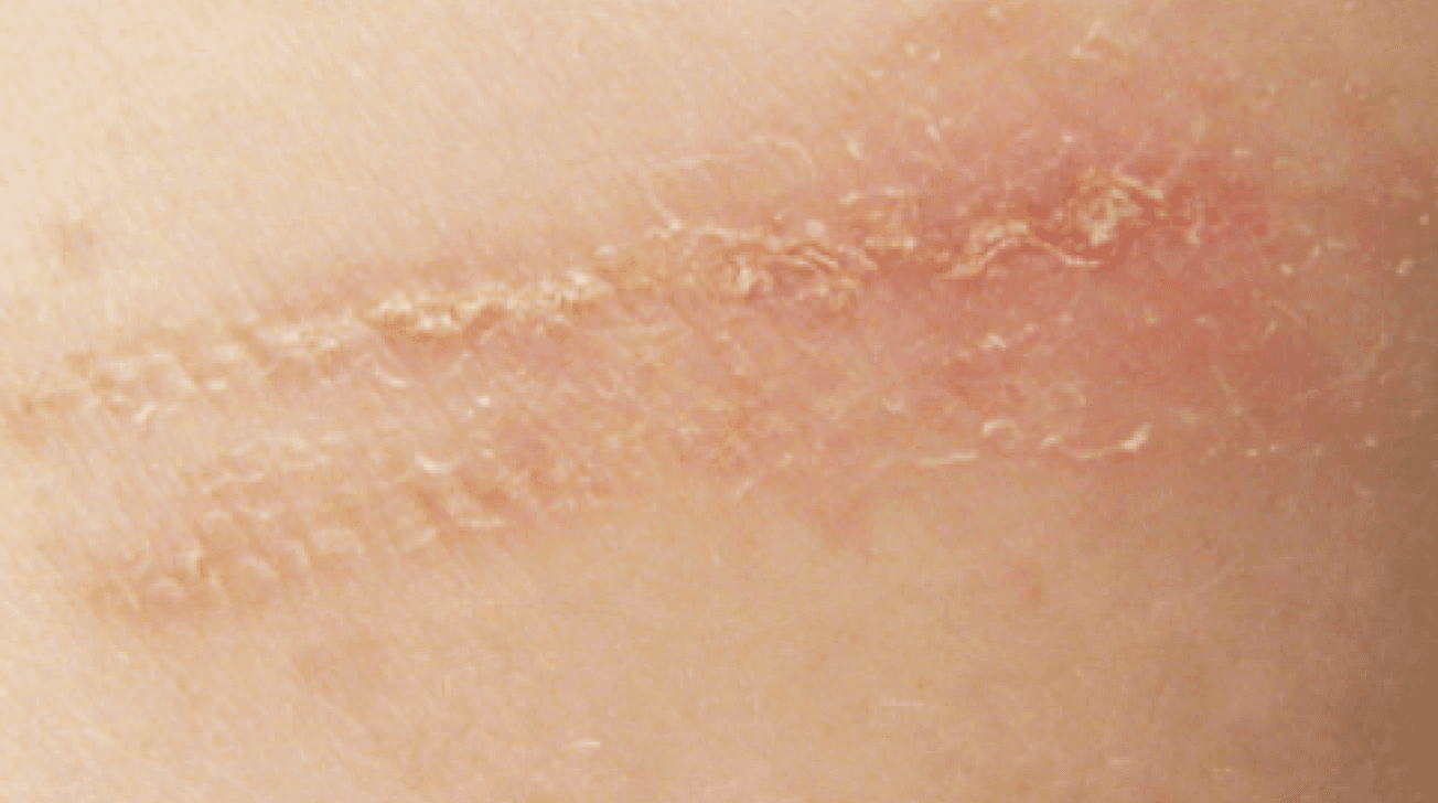 Skin photo, May 3
