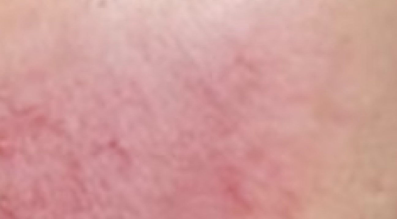 Skin photo, May 6
